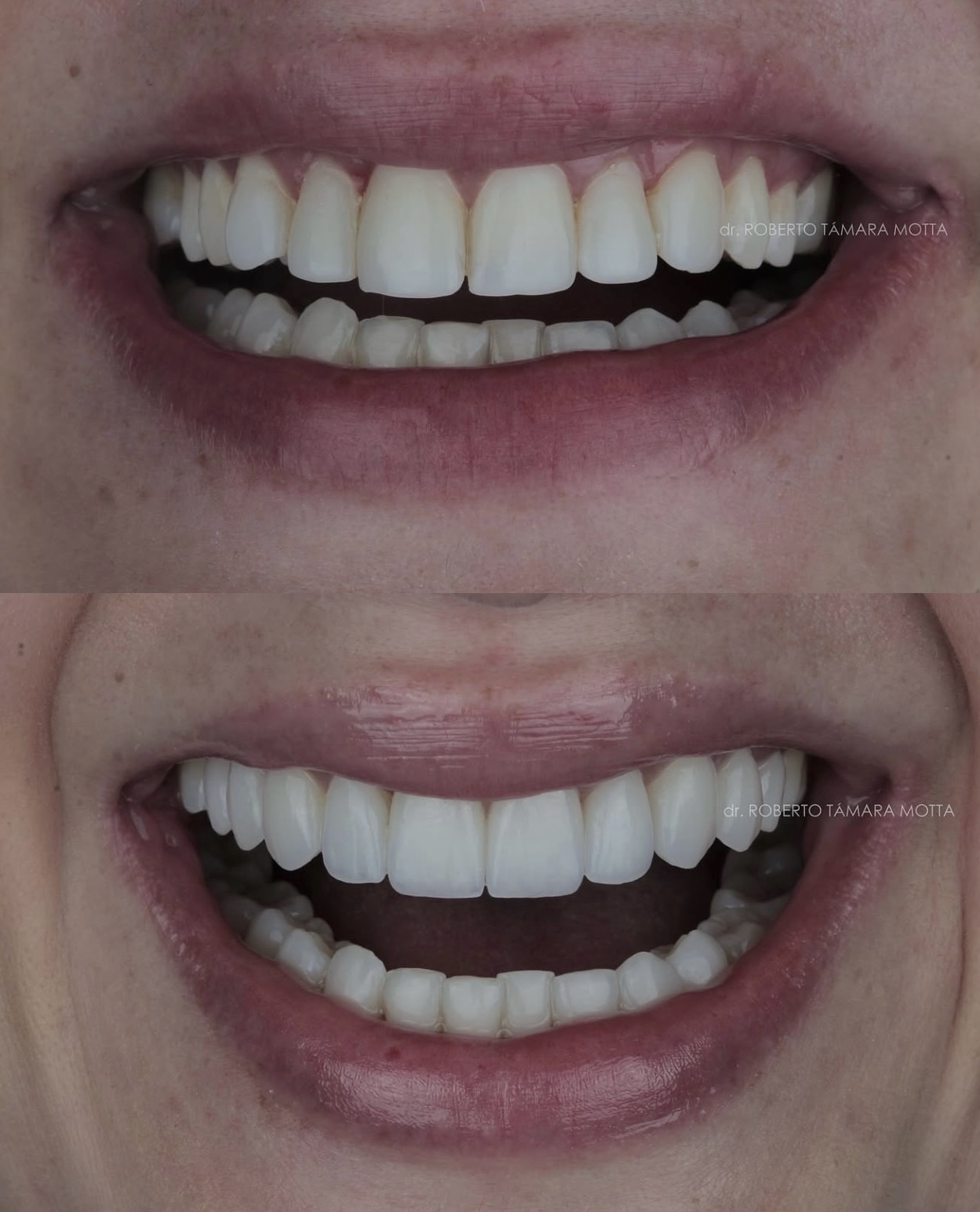 Veneers Colombia before after — Dr. Roberto Támara