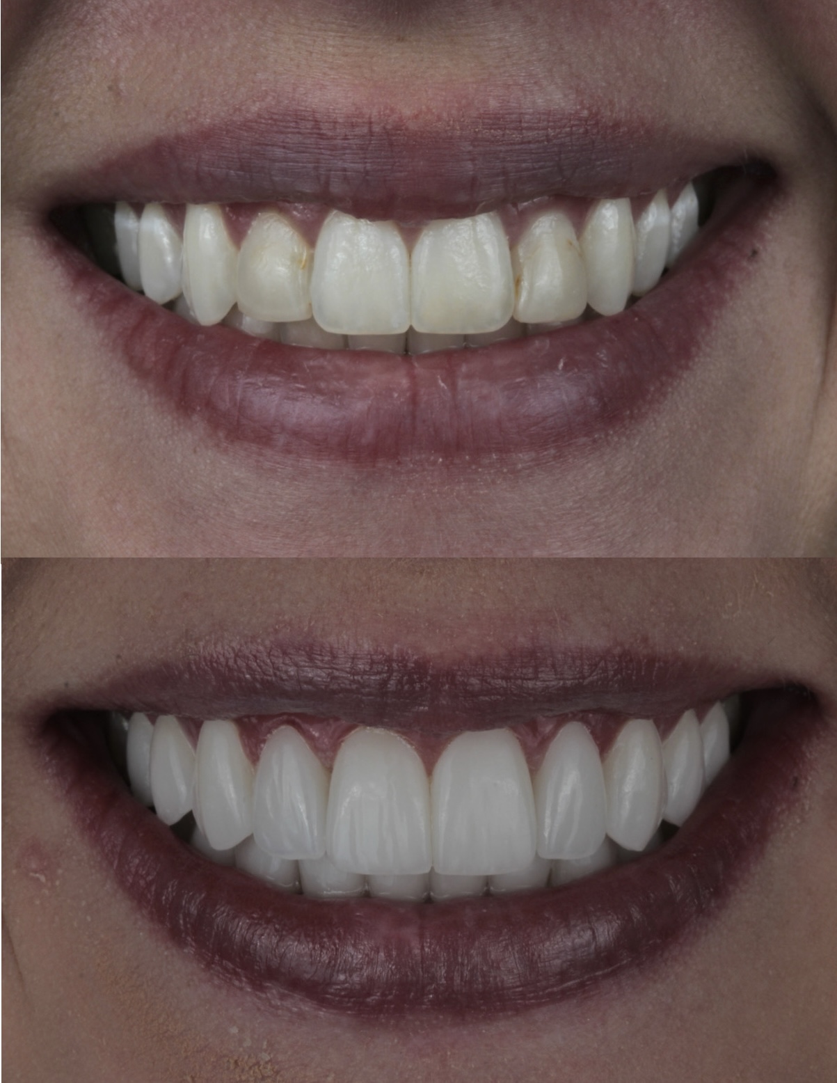 Porcelain veneers Bogotá before and after — Smile Atelier