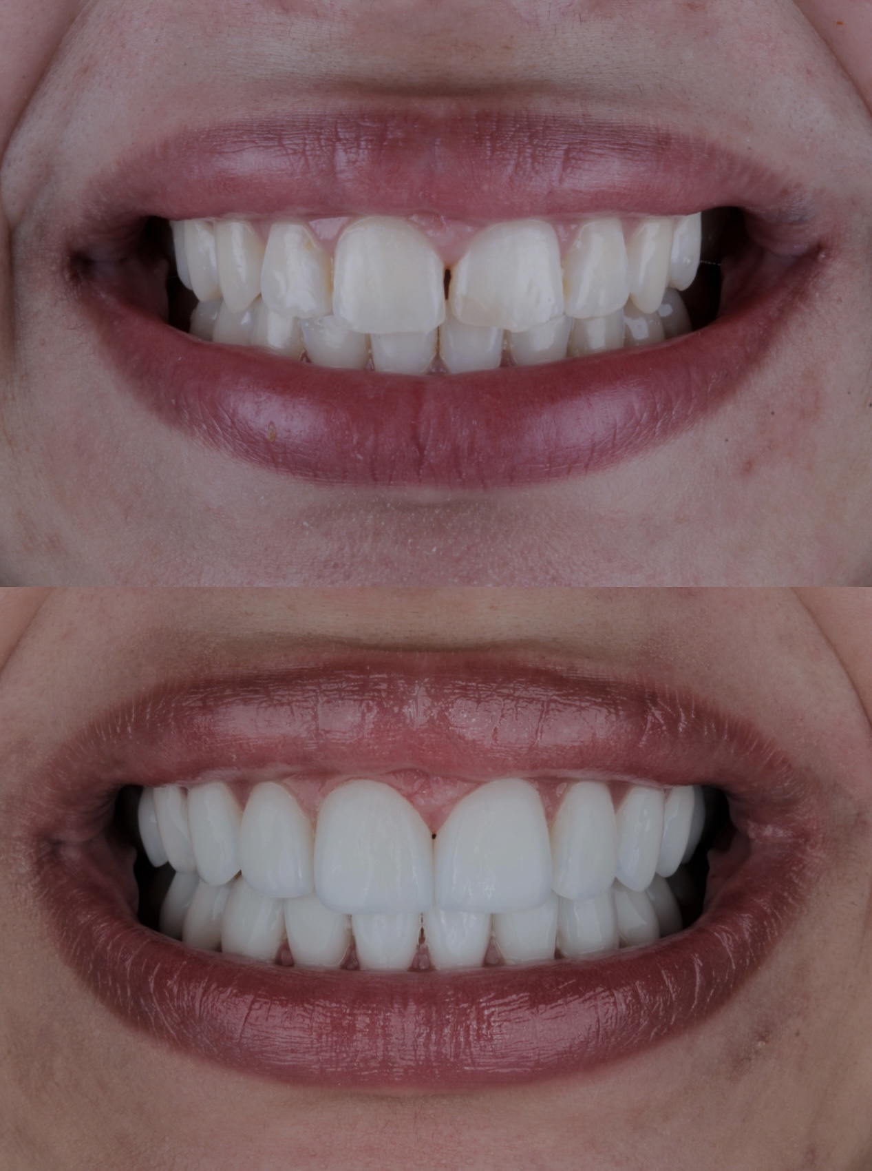 Smile makeover Bogotá before after