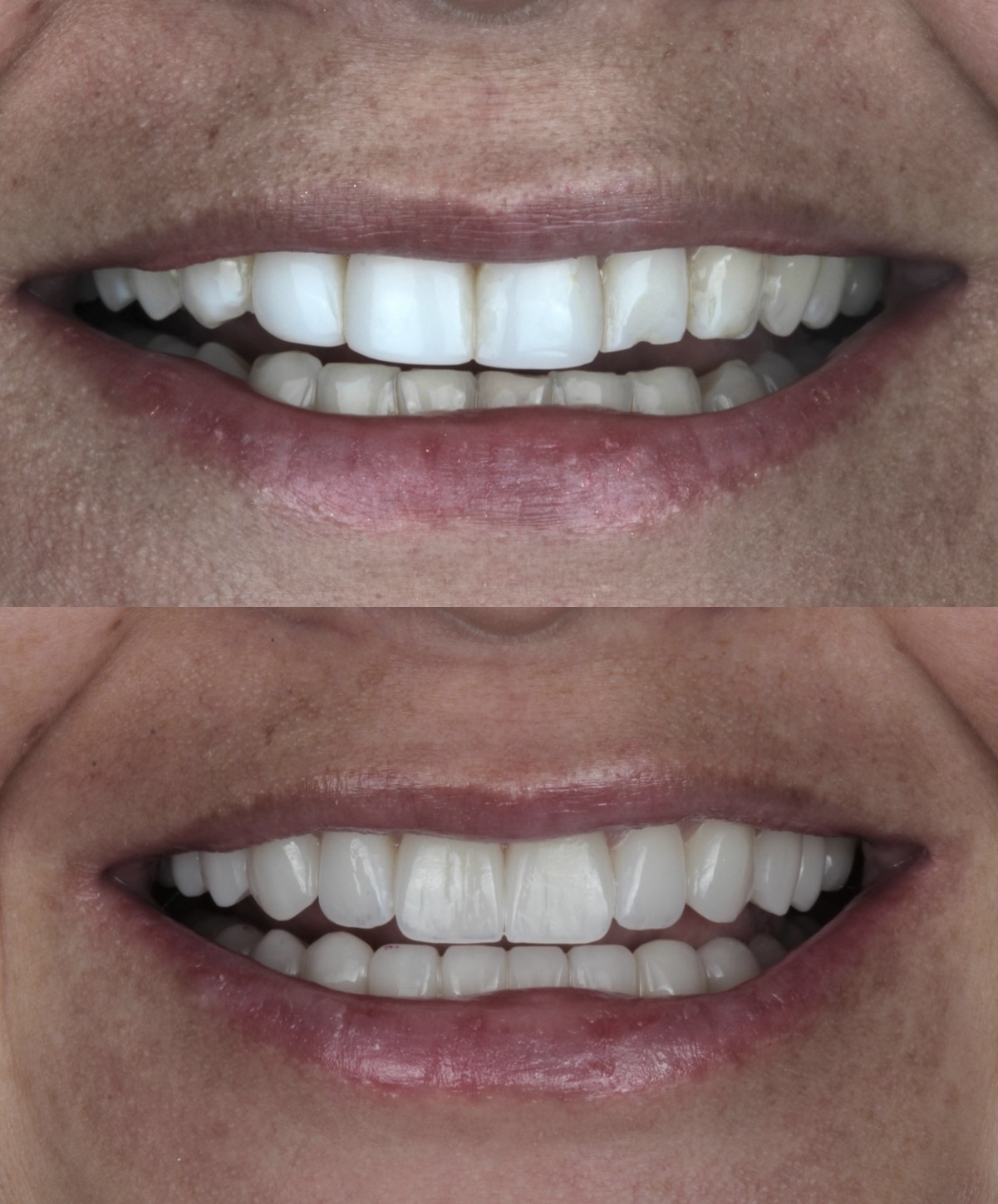 Dental veneers Bogotá Colombia results